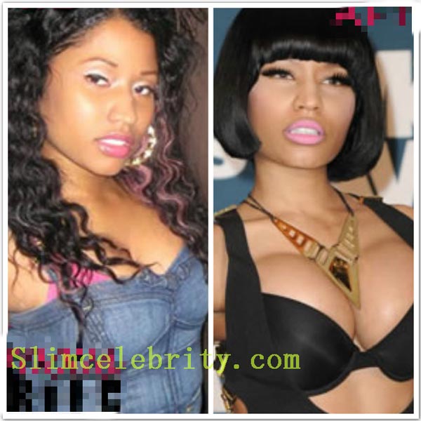 Nicki Minaj Breast Implants