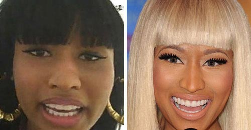 Nicki Minaj Nose Job Before & After