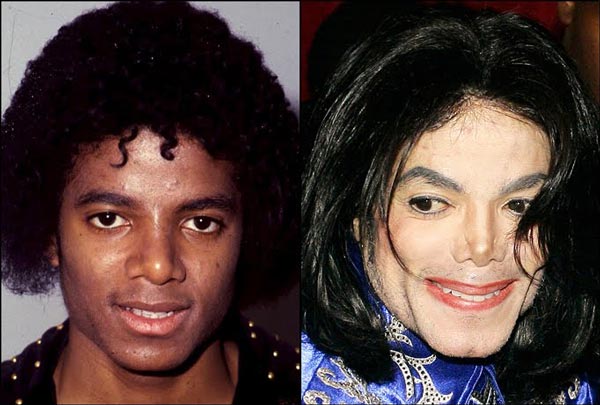 Michael Jackson Plastic Surgery Before & After