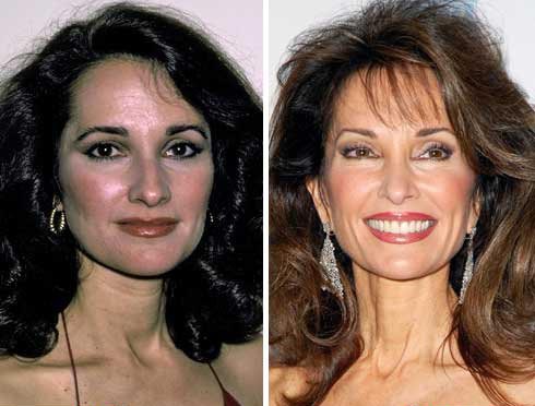 Susan Lucci Plastic Surgery Before & After