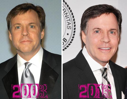 Bob Costas Plastic Surgery Before & After