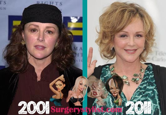 Bonnie Bedelia Plastic Surgery Before & After