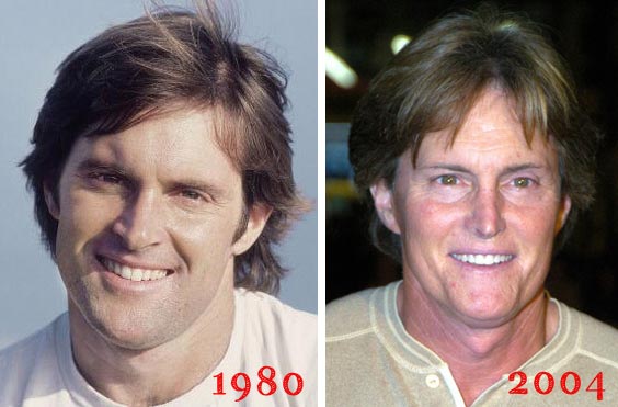 Bruce Jenner Plastic Surgery Before & After