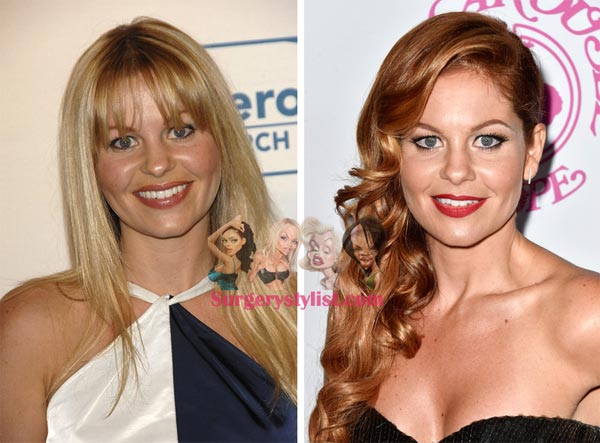 Candace Cameron Plastic Surgery Before & After