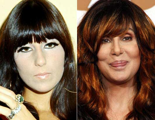 Cher Plastic Surgery Before & After Photo