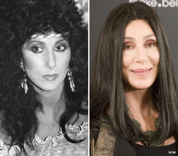 Cher Plastic Surgery Before & After