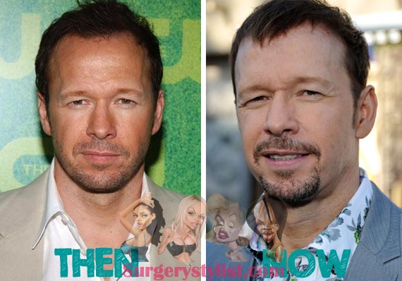 Donnie Wahlberg Plastic Surgery
