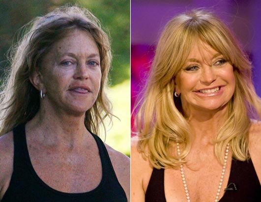 Goldie Hawn Plastic Surgery Before & After