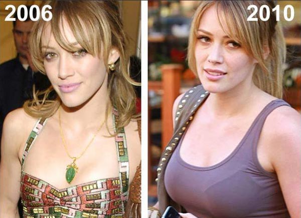 Hilary Duff Breast Implants