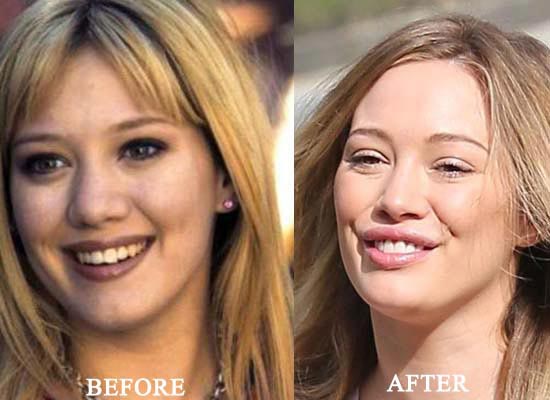 Hilary Duff Plastic Surgery Before & After