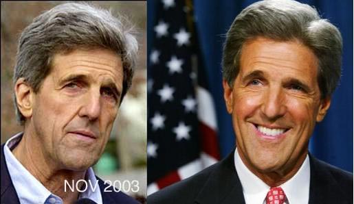 John Kerry Plastic Surgery Before & After