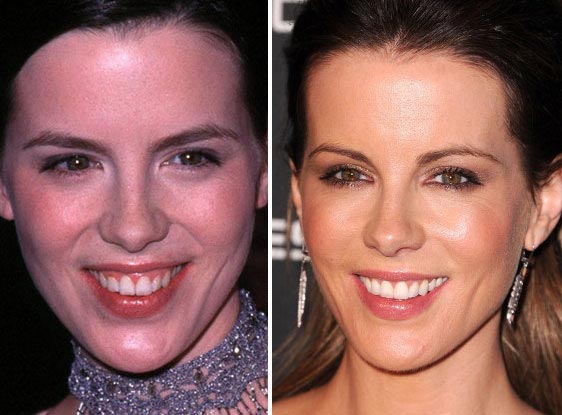 Kate Beckinsale Plastic Surgery Before & After