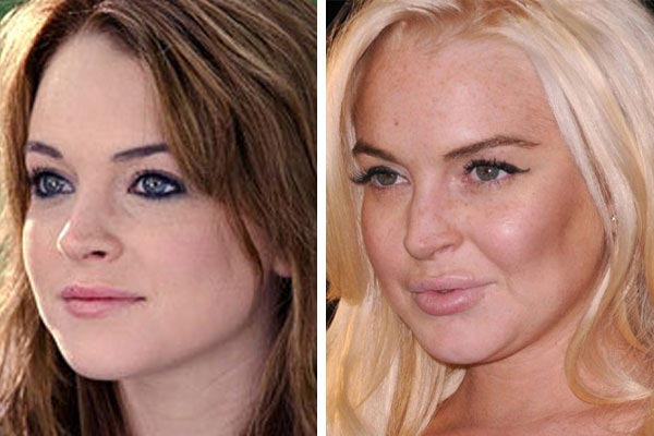 Lindsay Lohan Plastic Surgery Before & After