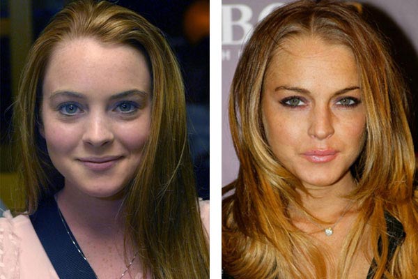 Lindsay Lohan Plastic Surgery