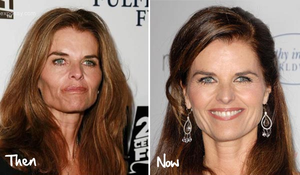 Maria Shriver Plastic Surgery Before & After