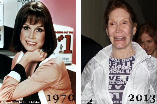 Mary Tyler Moore Plastic Surgery Before & After