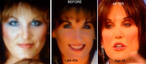 Robin McGraw Plastic Surgery Before & After