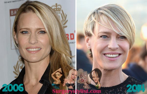 Robin Wright Penn Plastic Surgery Before & After