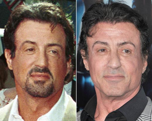 Sylvester Stallone Plastic Surgery Before & After