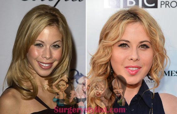 Tara Lipinski Plastic Surgery Before & After