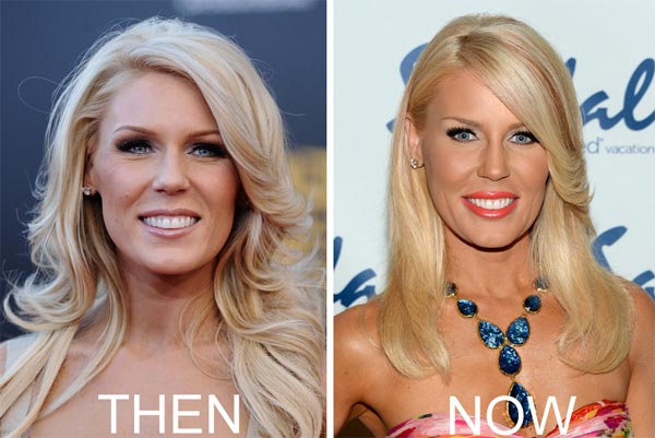 Gretchen Rossi Plastic Surgery Before & After