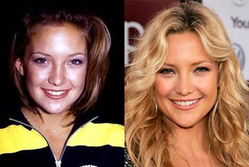 Kate Hudson Plastic Surgery Before & After