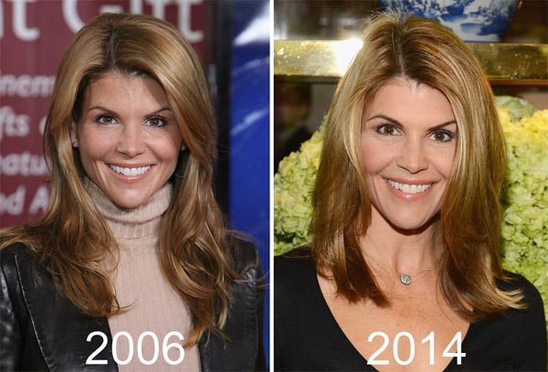 Lori Loughlin Plastic Surgery Before & After
