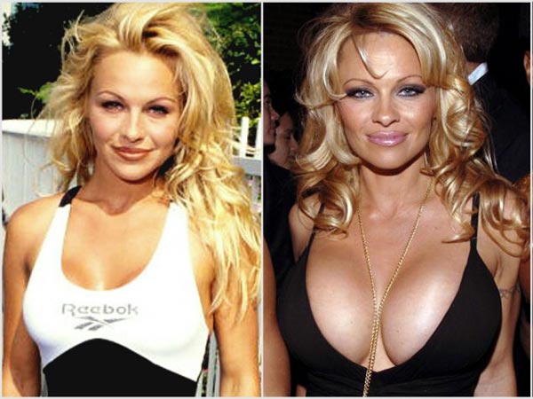 Pamela Anderson Breast Implants