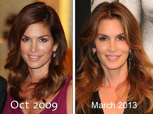 Cindy Crawford Plastic Surgery Before After