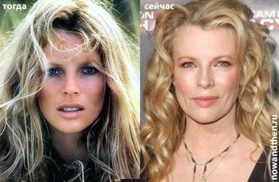 Kim Basinger Plastic Surgery Before & After