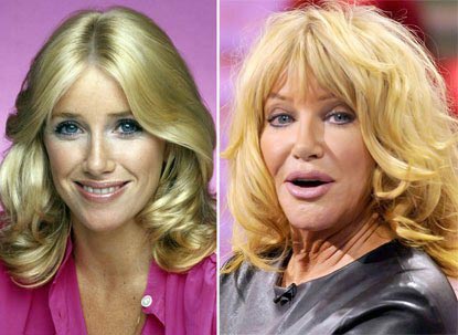 Suzanne Somers Plastic Surgery Before & After
