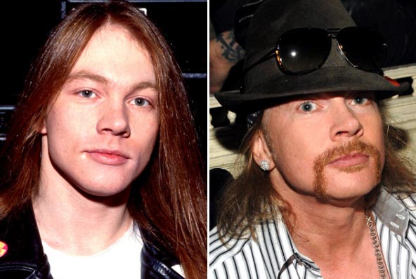 Axl Rose Plastic Surgery Before & After