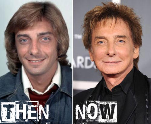 Barry Manilow Plastic Surgery Before After