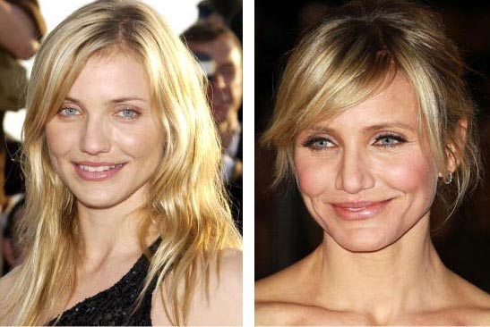 Cameron Diaz Plastic Surgery Before & After
