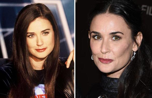 Demi Moore Plastic Surgery Before & After