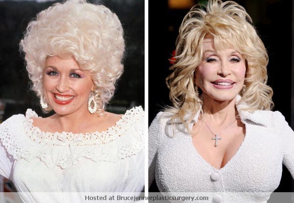 Dolly Parton Plastic Surgery Before & After