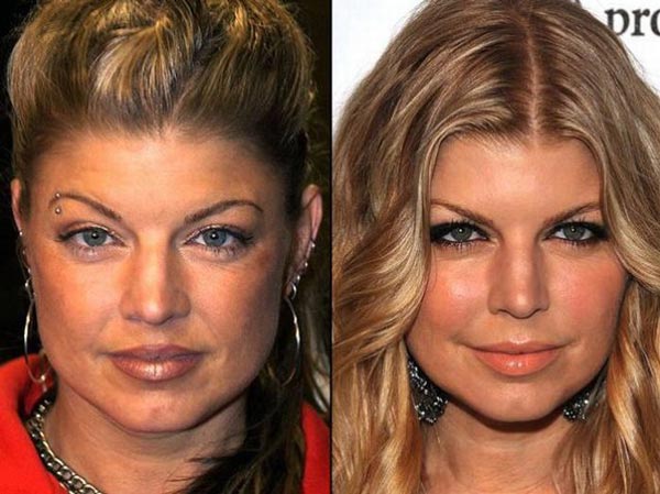 Fergie Plastic Surgery Before & After