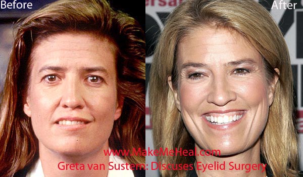 Greta Van Susteren Plastic Surgery Before & After