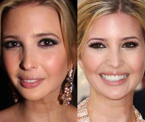 Ivanka Trump Plastic Surgery Before & After