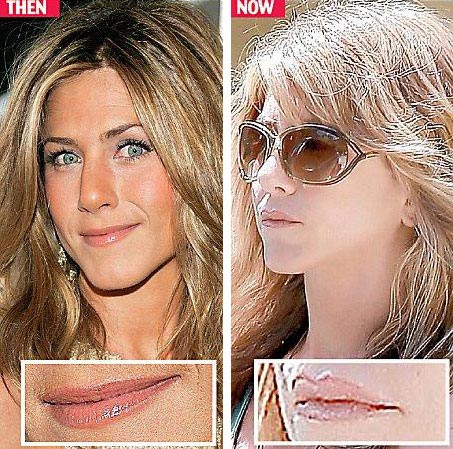 Jennifer Aniston Lip Injection