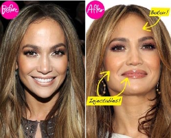 Jennifer Lopez Plastic Surgery Before & After