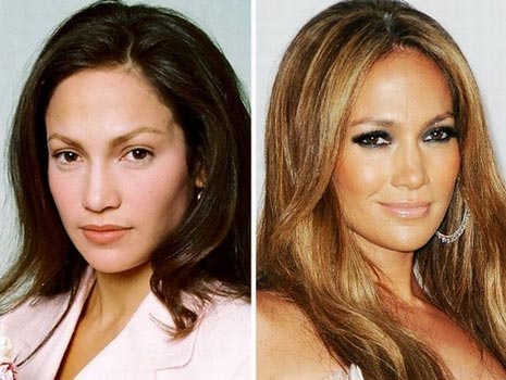 Jennifer Lopez Plastic Surgery Procedures