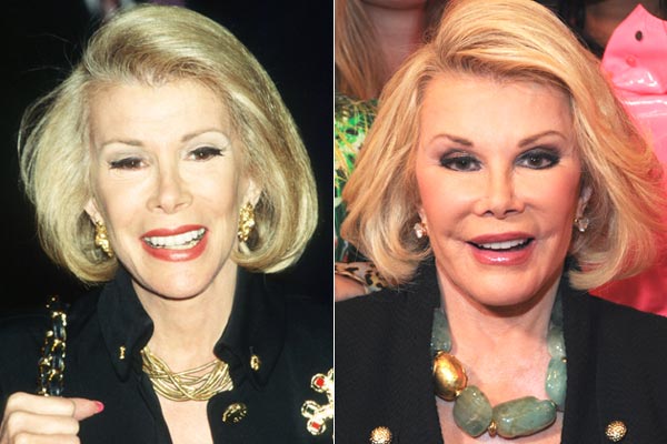 Joan Rivers Plastic Surgery Pictures