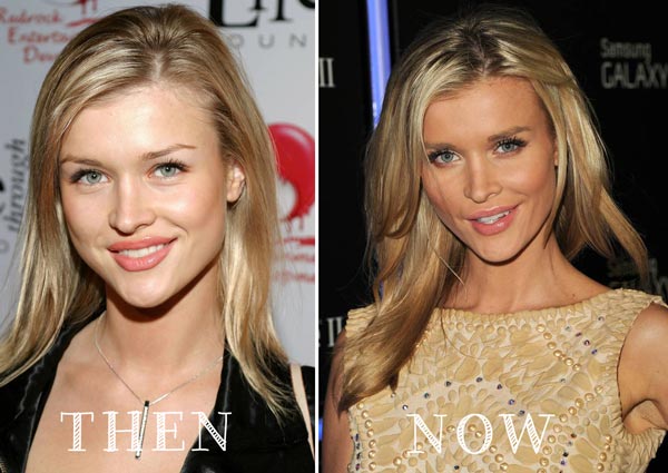 Joanna Krupa Plastic Surgery Before & After