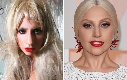 Lady Gaga Plastic Surgery Before & After