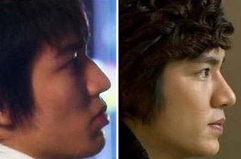 Lee Min Ho Plastic Surgery Before & After