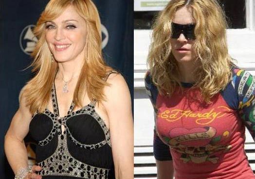Madonna Breast Implants