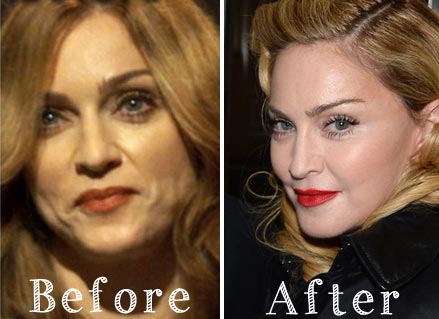 Madonna Plastic Surgery Before & After