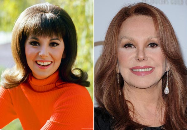 Marlo Thomas Plastic Surgery Before & After