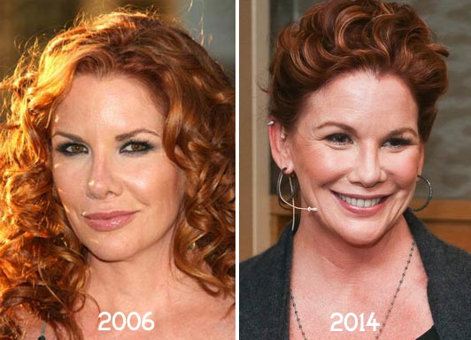 Melissa Gilbert Plastic Surgery Before & After